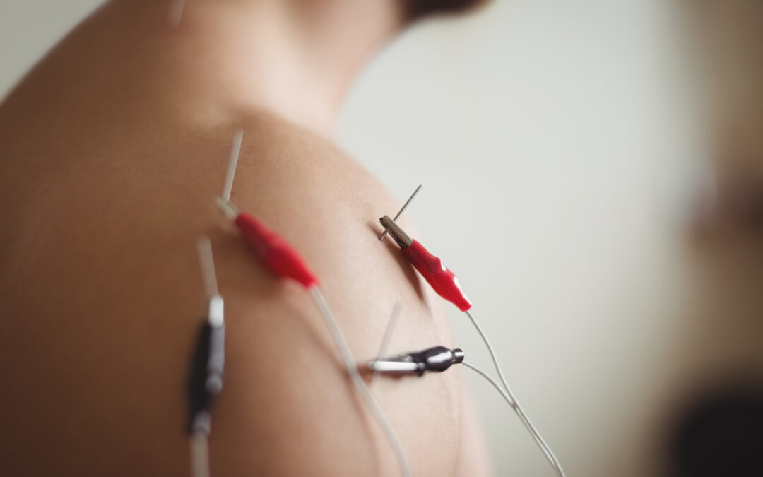 Electropunción en Zaragoza Sur: Tratamiento Avanzado para el Dolor Muscular y la Recuperación Funcional