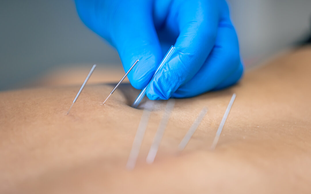 Punción Seca en Zaragoza Sur – Tratamiento Efectivo del Dolor Muscular en Valdespartera, Montecanal, Arcosur y Rosales del Canal